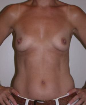 Breast Augmentation Gallery 49