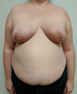 Breast Reduction Gallery 8