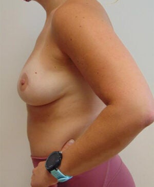 Breast Reconstruction Gallery 2