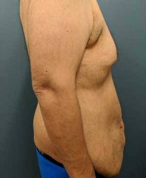 Body Contouring Gallery
